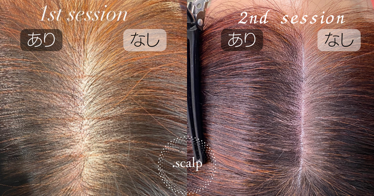 頭皮に描くヘアアートメイクで薄毛のお悩みを解消しませんか？ヘアアートメイクは痛みやダウンタイムはありません。近くで見ても本当の毛根にしか見えない自分の髪のような自然な仕上がりです。北陸金沢富山福井でヘアアートメイクするなら.SCALP（ドットスカルプ）で。
