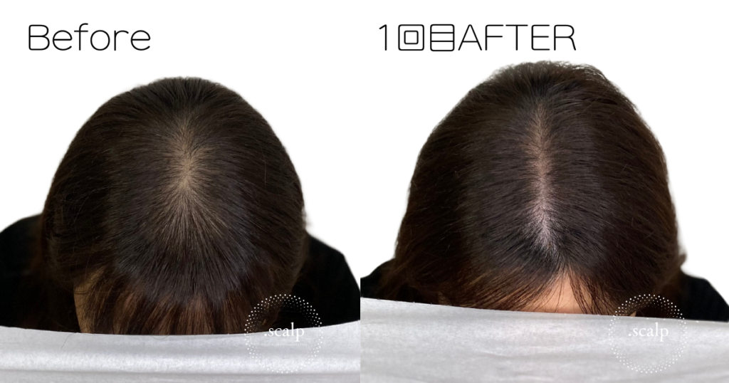 頭皮に描くヘアアートメイクで薄毛のお悩みを解消しませんか?ヘアアートメイクは痛みやダウンタイムはありません。近くで見ても本当の毛根にしか見えない自分の髪のような自然な仕上がりです。北陸金沢富山福井でヘアアートメイクするなら.SCALP(ドットスカルプ)で。
