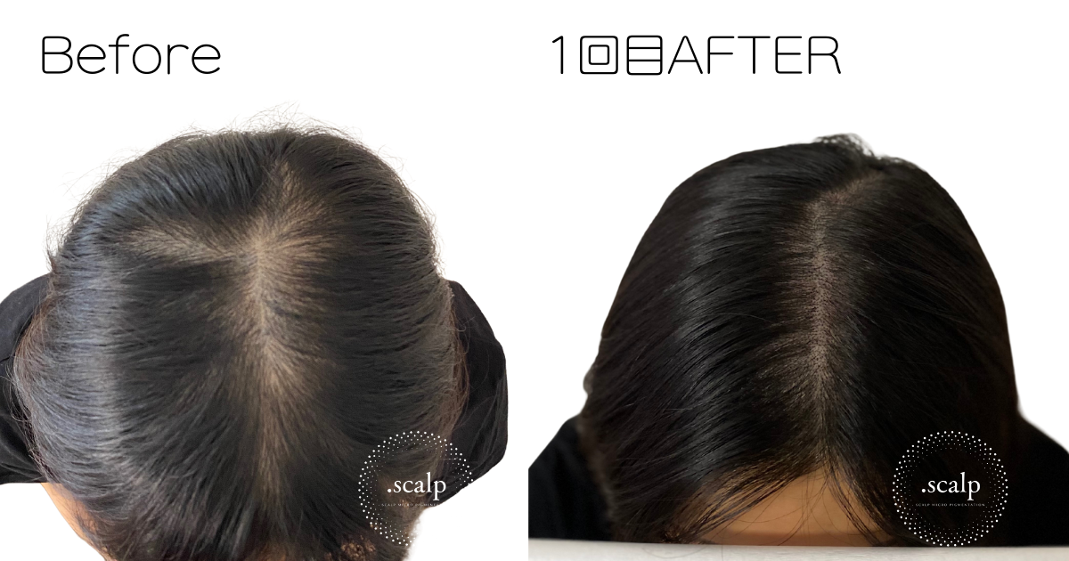 頭皮に描くヘアアートメイクで薄毛のお悩みを解消しませんか？ヘアアートメイクは痛みやダウンタイムはありません。近くで見ても本当の毛根にしか見えない自分の髪のような自然な仕上がりです。北陸金沢富山福井でヘアアートメイクするなら.SCALP（ドットスカルプ）で。