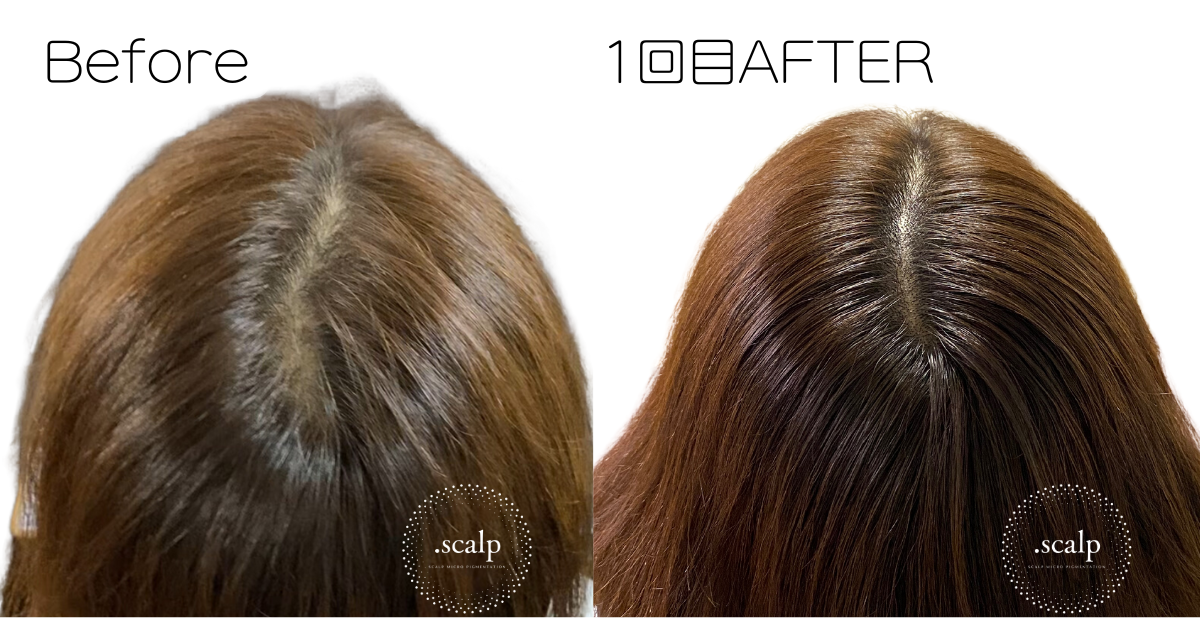 頭皮に描くヘアアートメイクで薄毛のお悩みを解消しませんか？ヘアアートメイクは痛みやダウンタイムはありません。近くで見ても本当の毛根にしか見えない自分の髪のような自然な仕上がりです。北陸金沢富山福井でヘアアートメイクするなら.SCALP（ドットスカルプ）で。