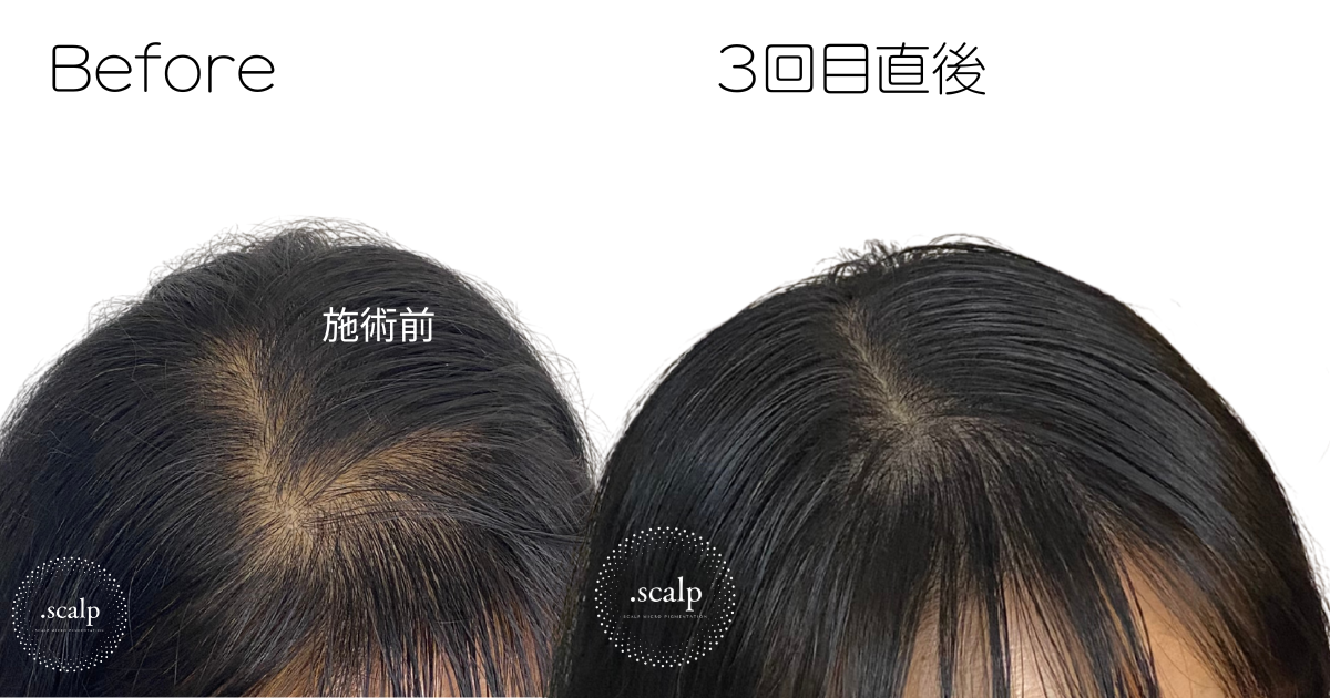頭皮に描くヘアアートメイクで薄毛のお悩みを解消しませんか？ヘアアートメイクは痛みやダウンタイムはありません。近くで見ても本当の毛根にしか見えない自分の髪のような自然な仕上がりです。北陸金沢富山福井でヘアアートメイクするなら.SCALP（ドットスカルプ）で。