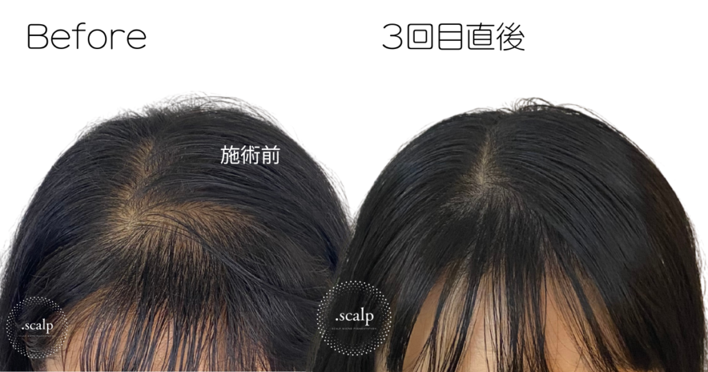 頭皮に描くヘアアートメイクで薄毛のお悩みを解消しませんか？ヘアアートメイクは痛みやダウンタイムはありません。近くで見ても本当の毛根にしか見えない自分の髪のような自然な仕上がりです。北陸金沢富山福井でヘアアートメイクするなら.SCALP（ドットスカルプ）で。