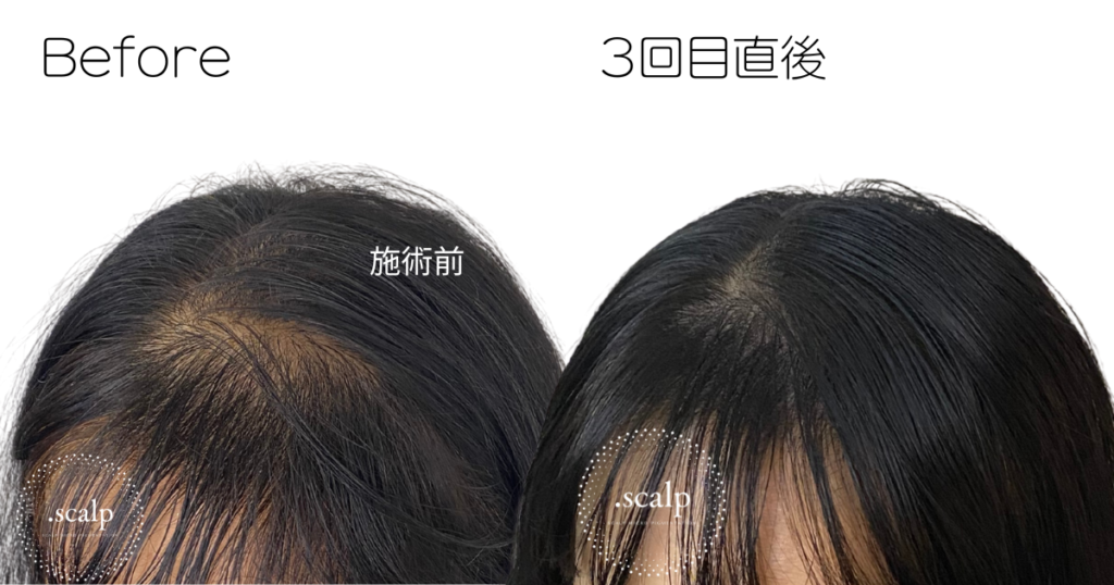 頭皮に描くヘアアートメイクで薄毛のお悩みを解消しませんか？ヘアアートメイクは痛みやダウンタイムはありません。近くで見ても本当の毛根にしか見えない自分の髪のような自然な仕上がりです。北陸金沢富山福井でヘアアートメイクするなら.SCALP（ドットスカルプ）で。